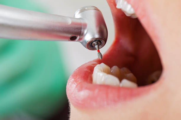 Best Knocked-Out Tooth (Avulsed Tooth) Treatment in Lawton, IA